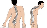 脊柱侧弯症状和病因有哪些  揭示三种原因及症状表现